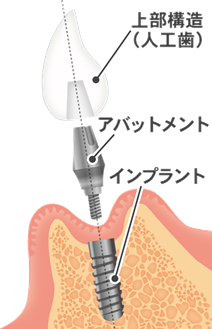 implant01.png